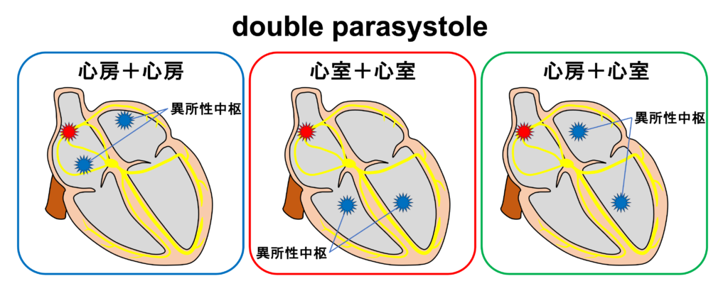 double ventricular parasystole重複副収縮