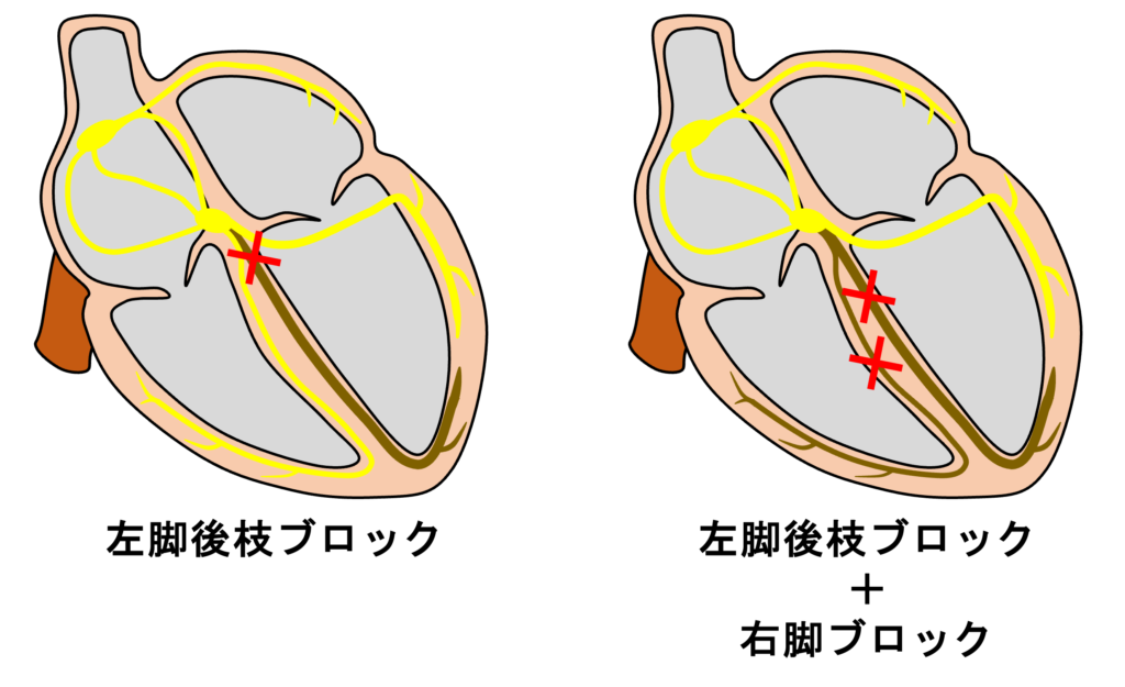 左脚後枝ブロック(left posterior fascicular block:LPFB)