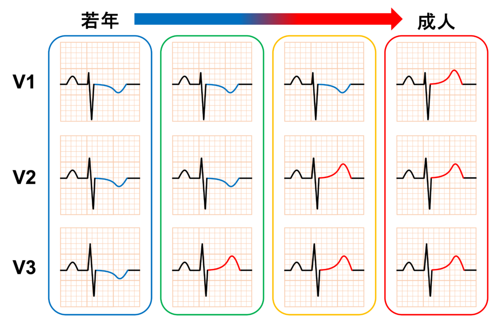 若年性T波(Juvenile T wave)