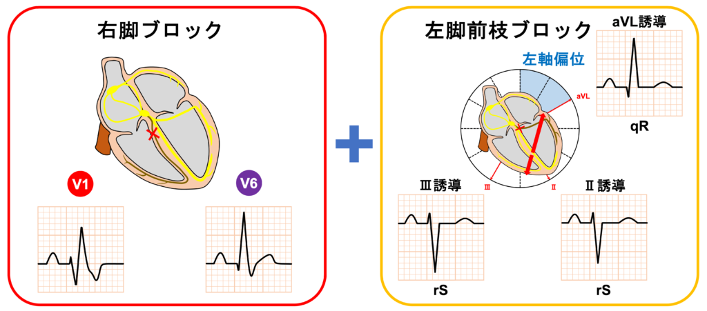 2枝ブロック(bifascicular block)