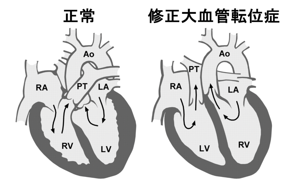 修正大血管転位症(corrected transposition of great arteries)