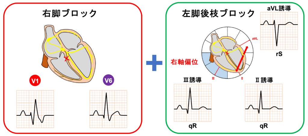2枝ブロック(bifascicular block)