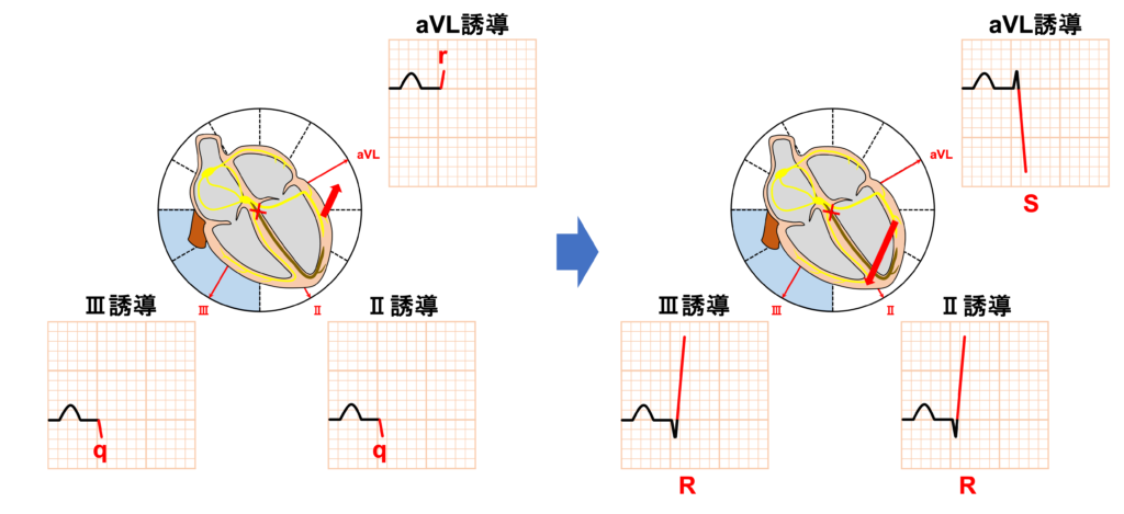 左脚後枝ブロック(left posterior fascicular block:LPFB)
