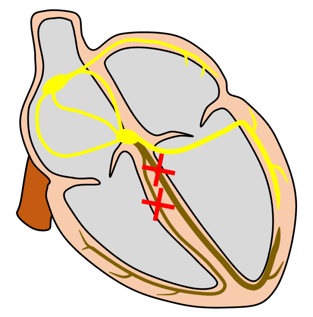 2枝ブロック(bifascicular block)