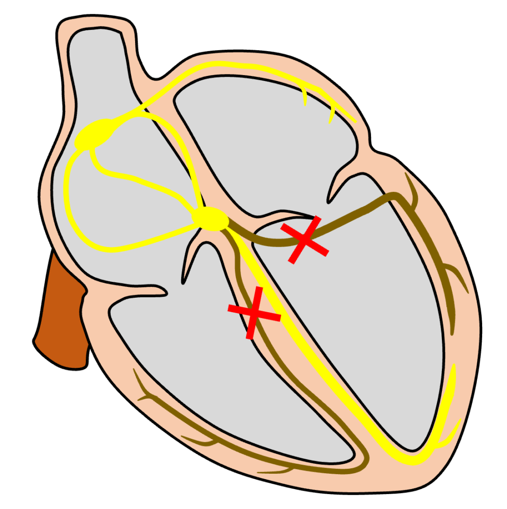 2枝ブロック(bifascicular block)