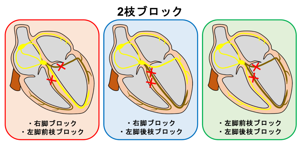 2枝ブロック(bifascicular block)