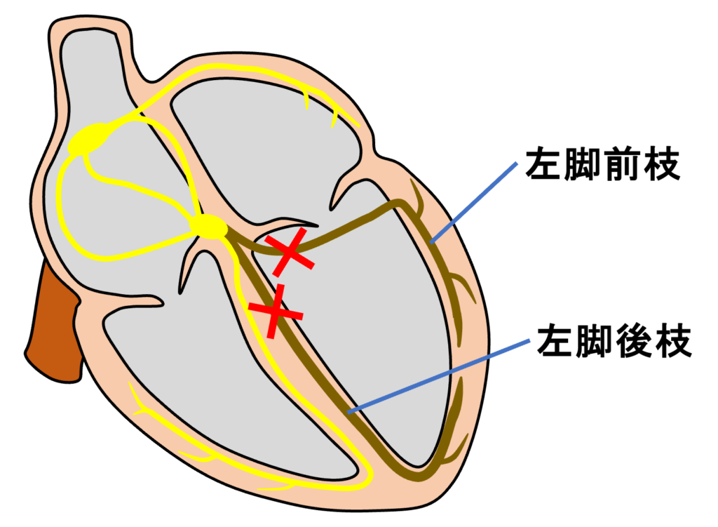 2枝ブロック(bifascicular block)