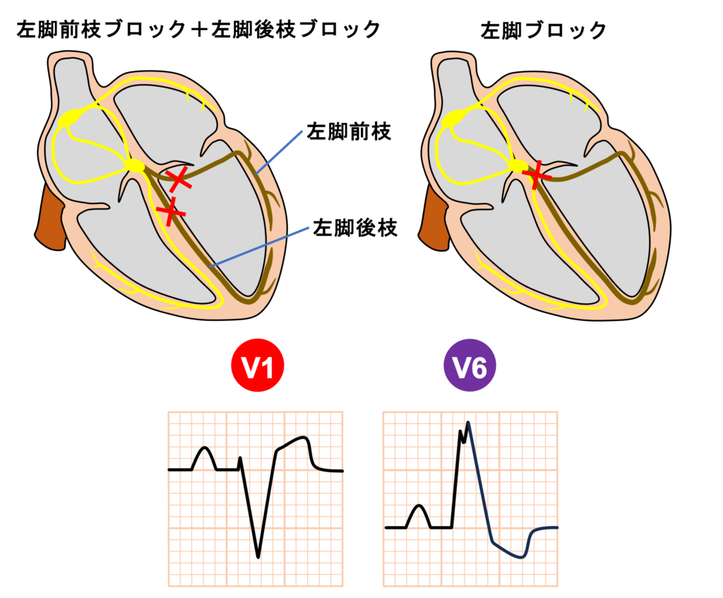 2枝ブロック(bifascicular block)