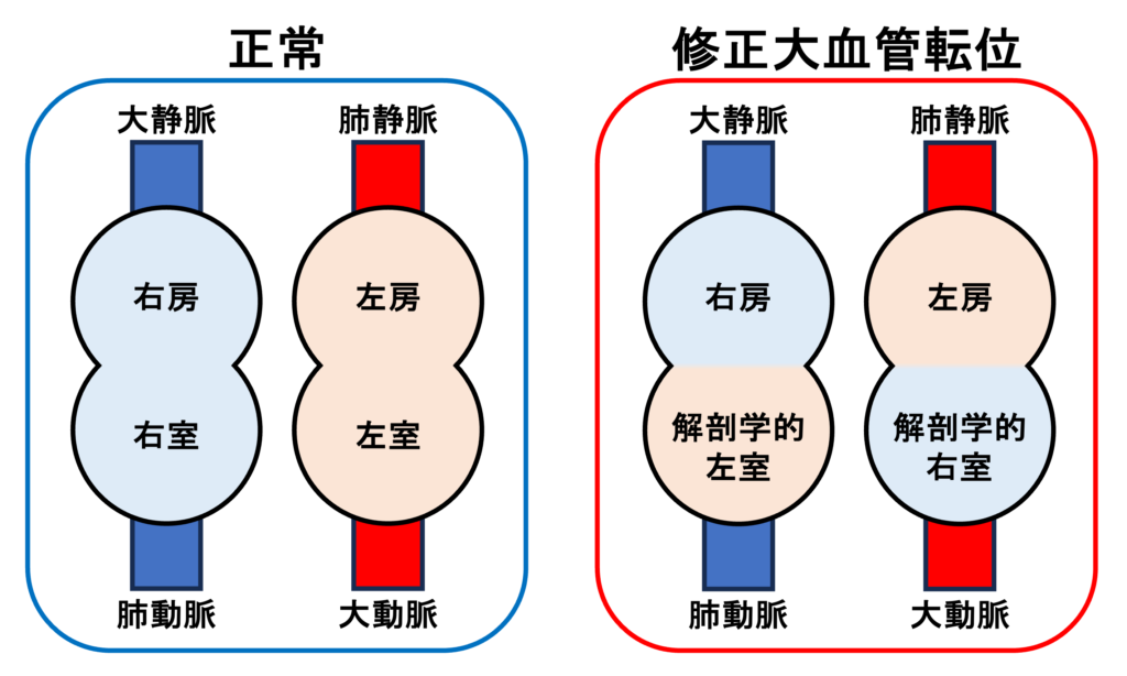 修正大血管転位症(corrected transposition of great arteries)