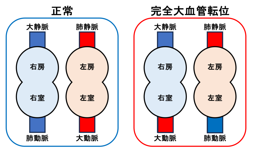 完全大血管転位(complete transposition of great arteries)