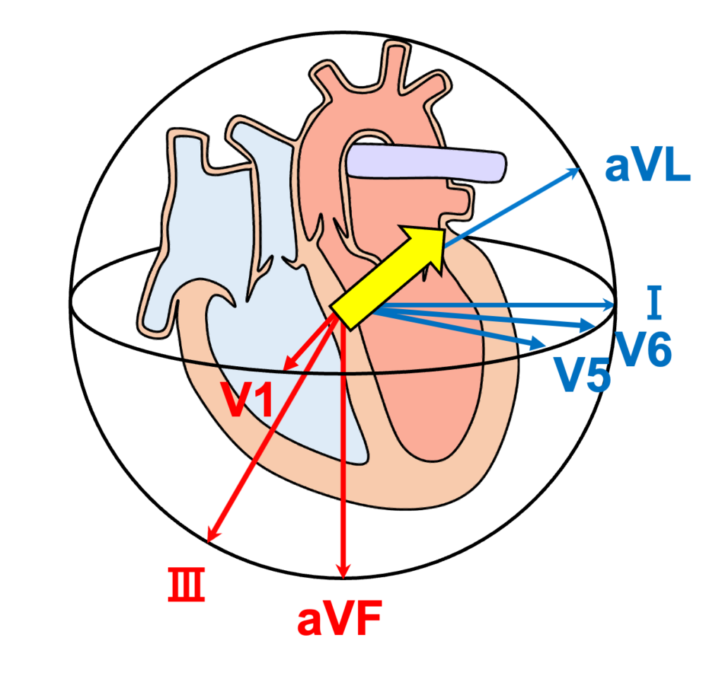 修正大血管転位症(corrected transposition of great arteries)