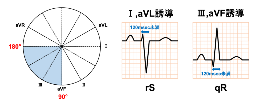 左脚後枝ブロック(left posterior fascicular block:LPFB)