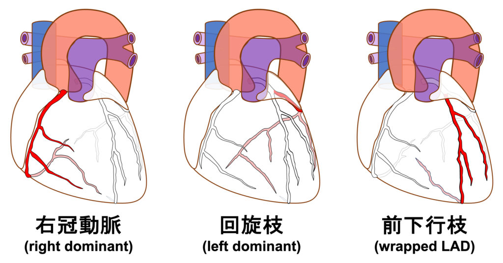 下壁心筋梗塞(inferior myocardial infarction)