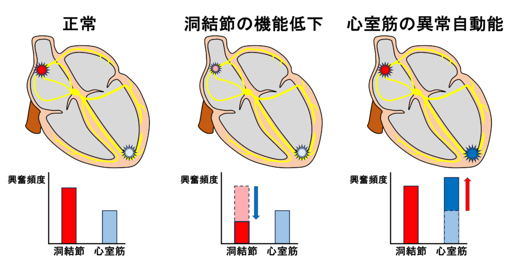 促進性心室固有調律(accelerated idioventricular rhythm:AIVR)