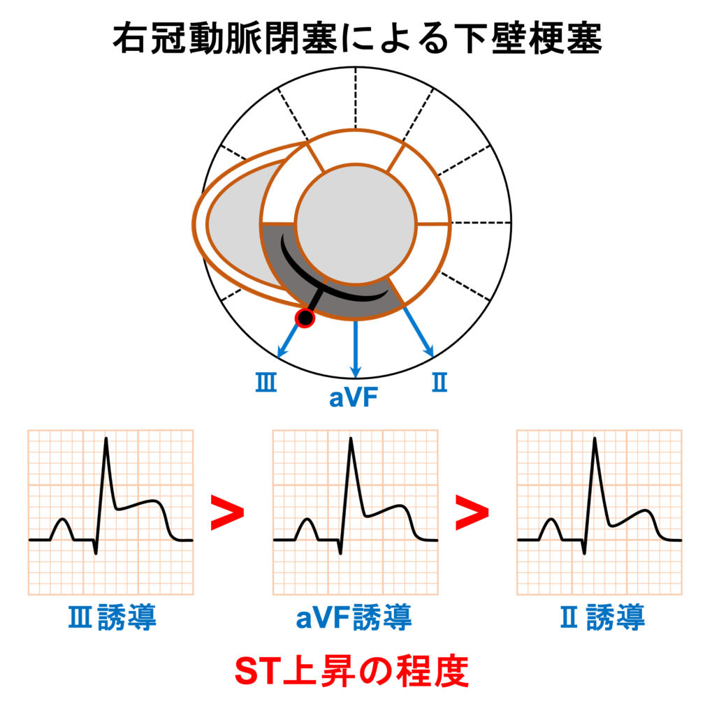 下壁心筋梗塞(inferior myocardial infarction)