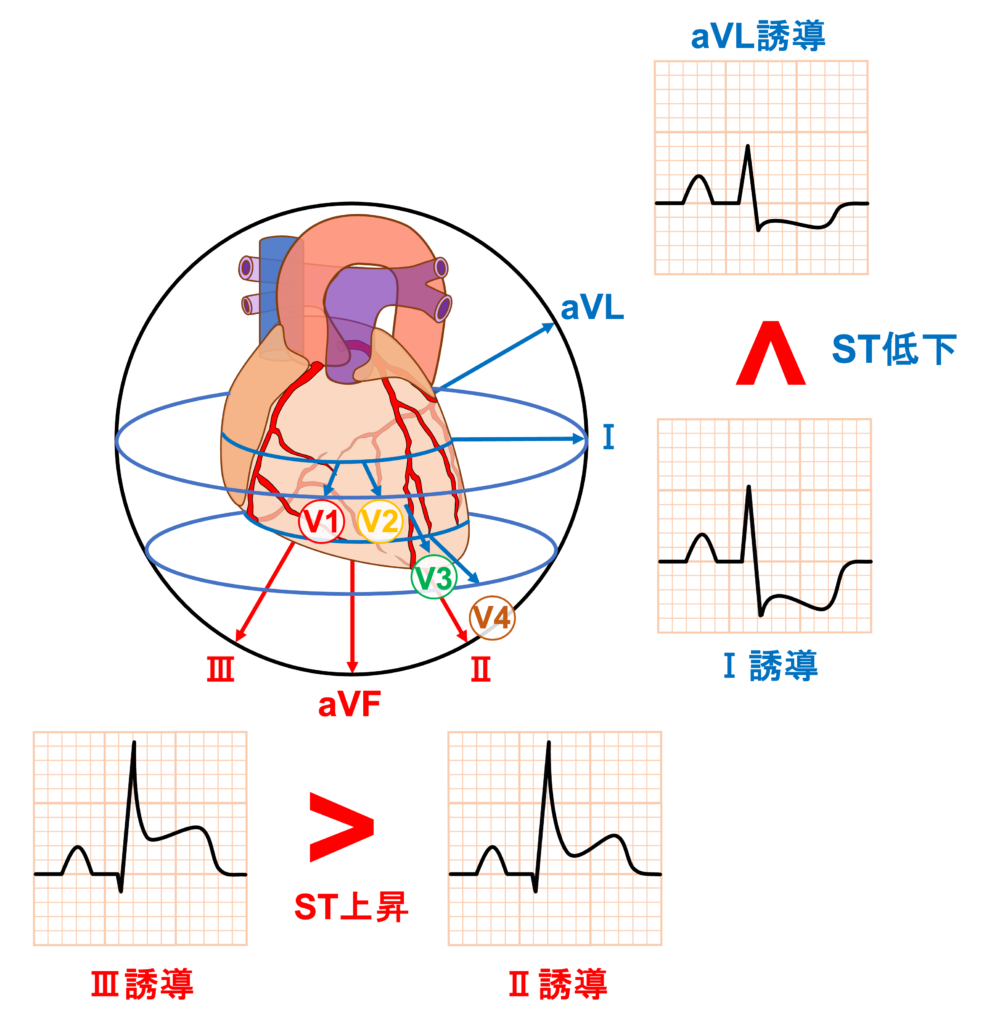下壁心筋梗塞(inferior myocardial infarction)