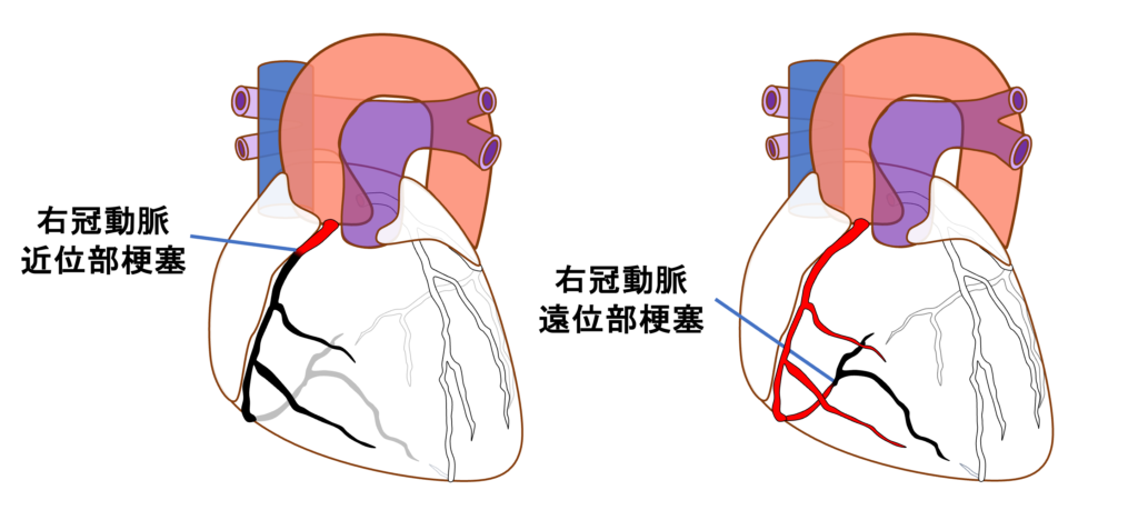 下壁心筋梗塞(inferior myocardial infarction)