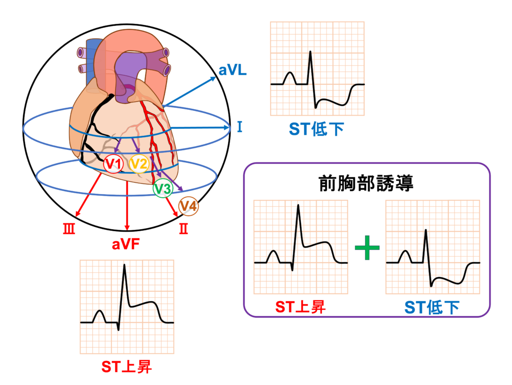 下壁心筋梗塞(inferior myocardial infarction)