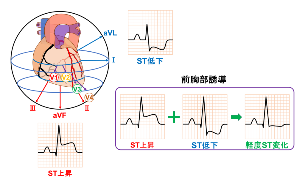 下壁心筋梗塞(inferior myocardial infarction)