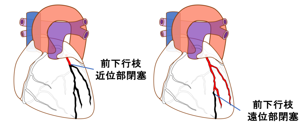 前壁心筋梗塞(anterior myocardial infarction)