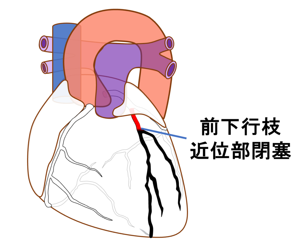前壁心筋梗塞(anterior myocardial infarction)