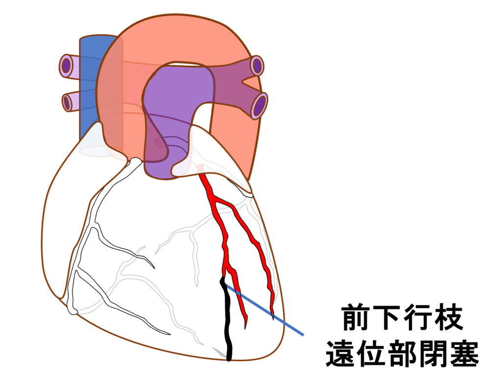 前壁心筋梗塞(anterior myocardial infarction)