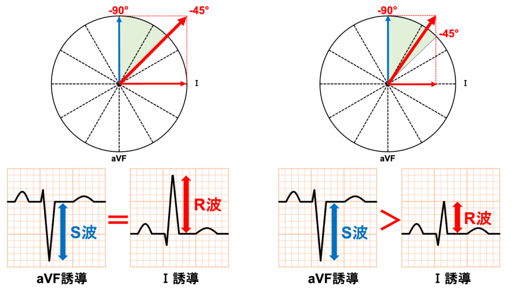 左脚前枝ブロック(left anterior fascicle block)