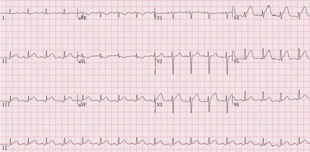 wrapped LAD(wrapped left anterior descending artery)