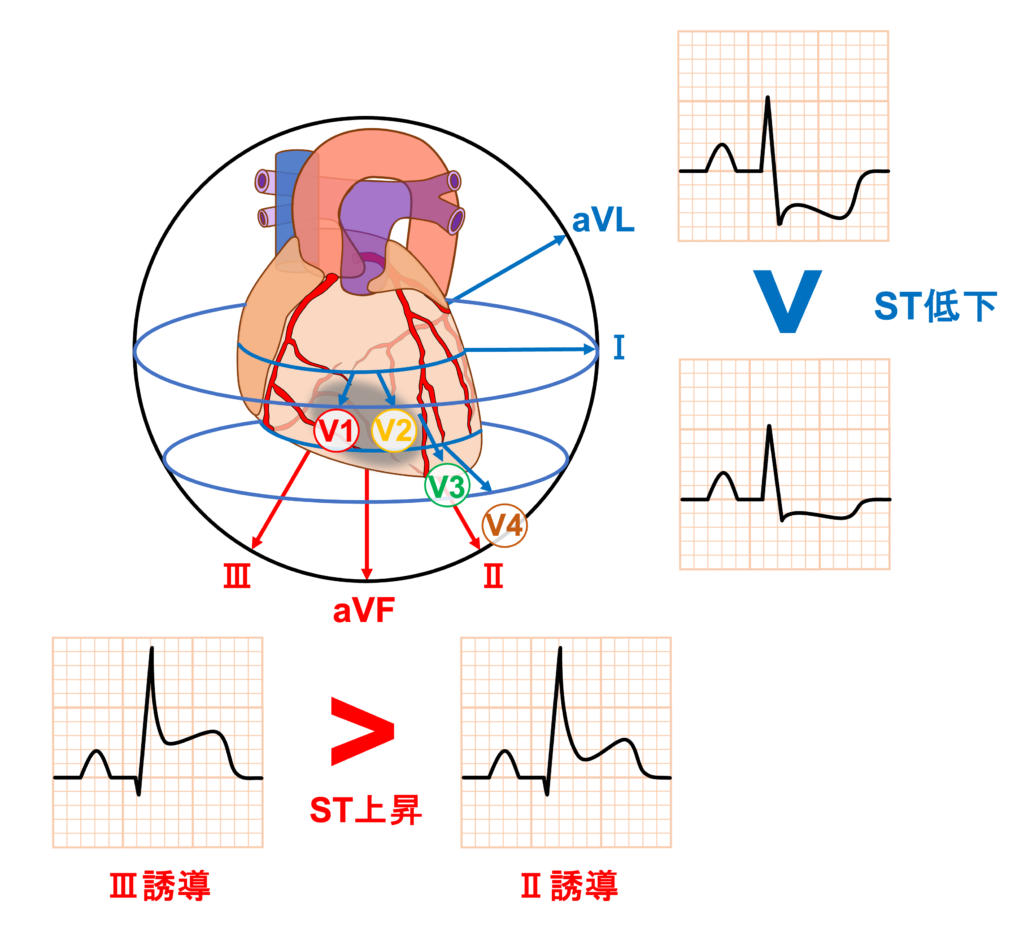 下壁心筋梗塞(inferior myocardial infarction)