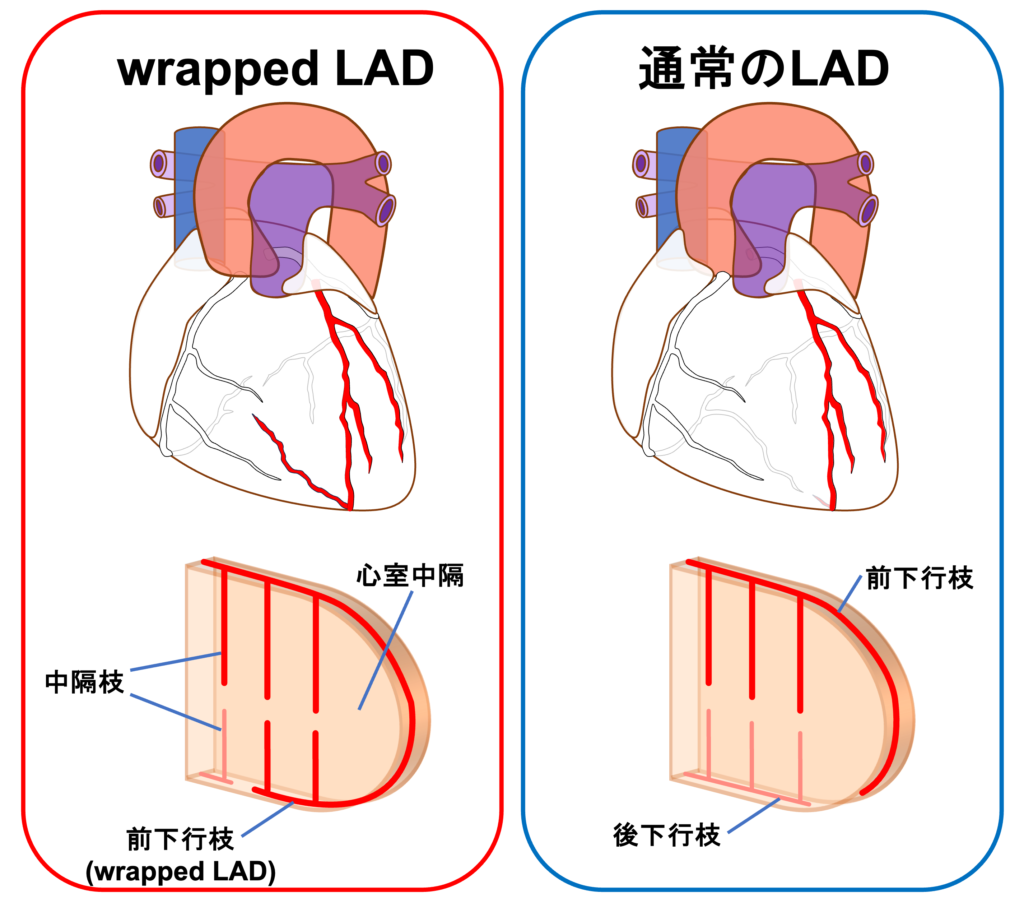 wrapped LAD(wrapped left anterior descending artery)