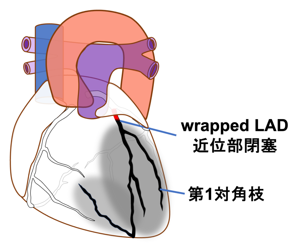 wrapped LAD(wrapped left anterior descending artery)