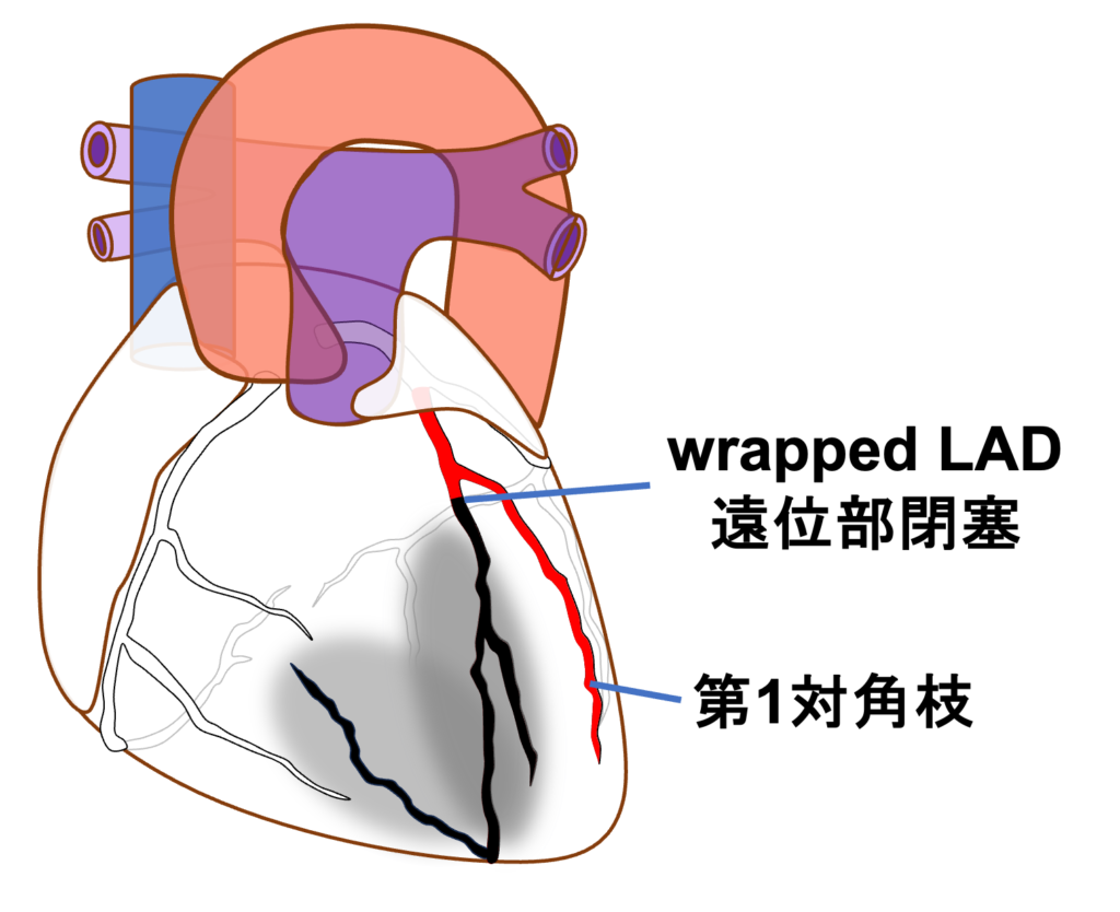 wrapped LAD(wrapped left anterior descending artery)