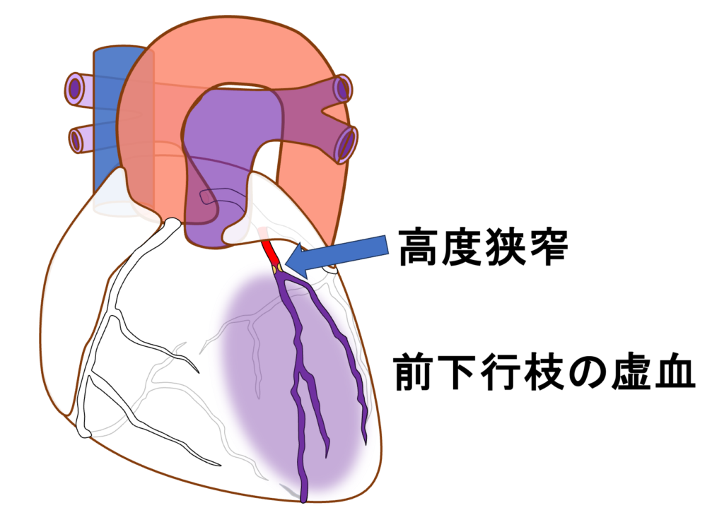 Wellens症候群(Wellens syndrome)