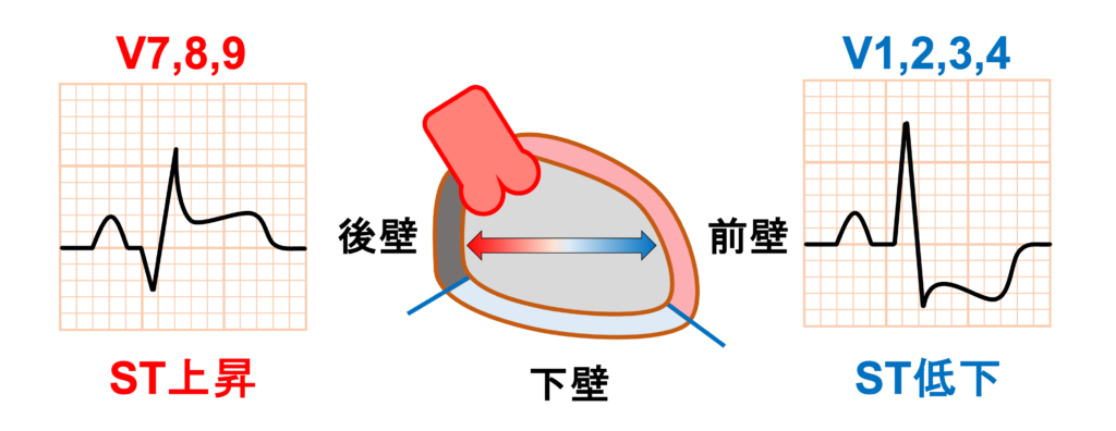 後壁心筋梗塞(posterior myocardial infarction)