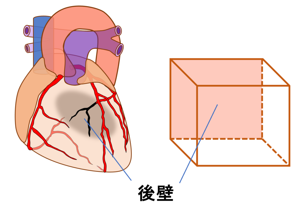 後壁心筋梗塞(posterior myocardial infarction)