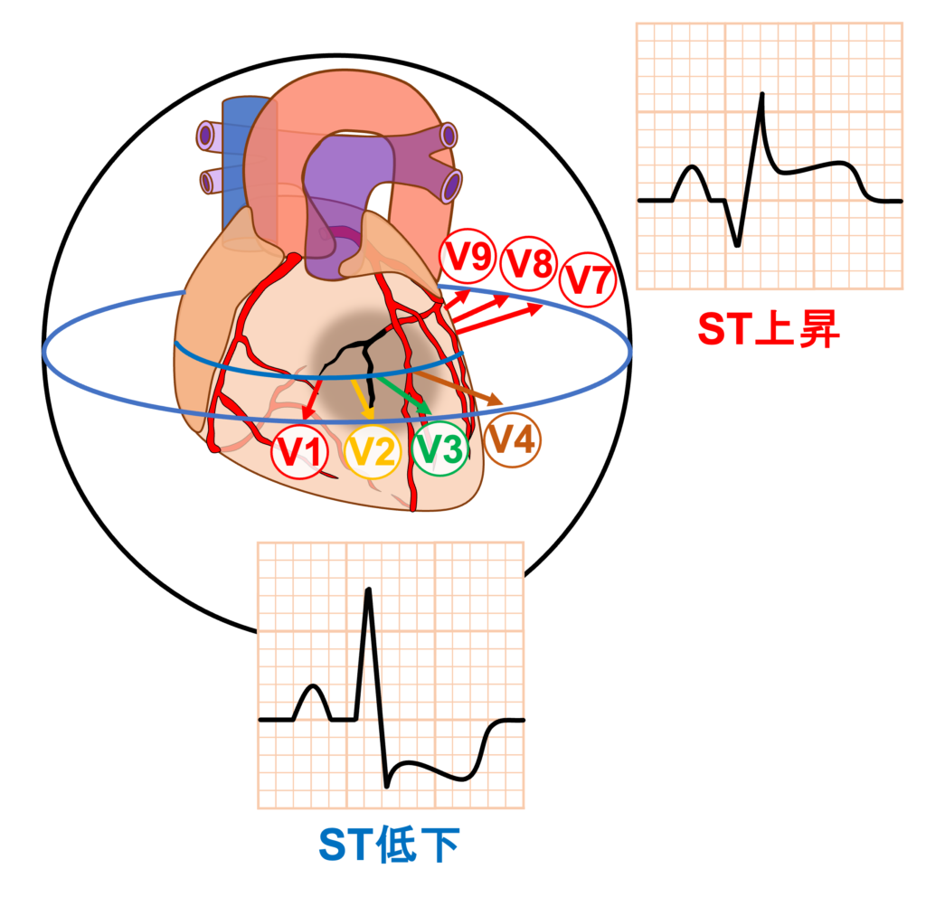 後壁心筋梗塞(posterior myocardial infarction)