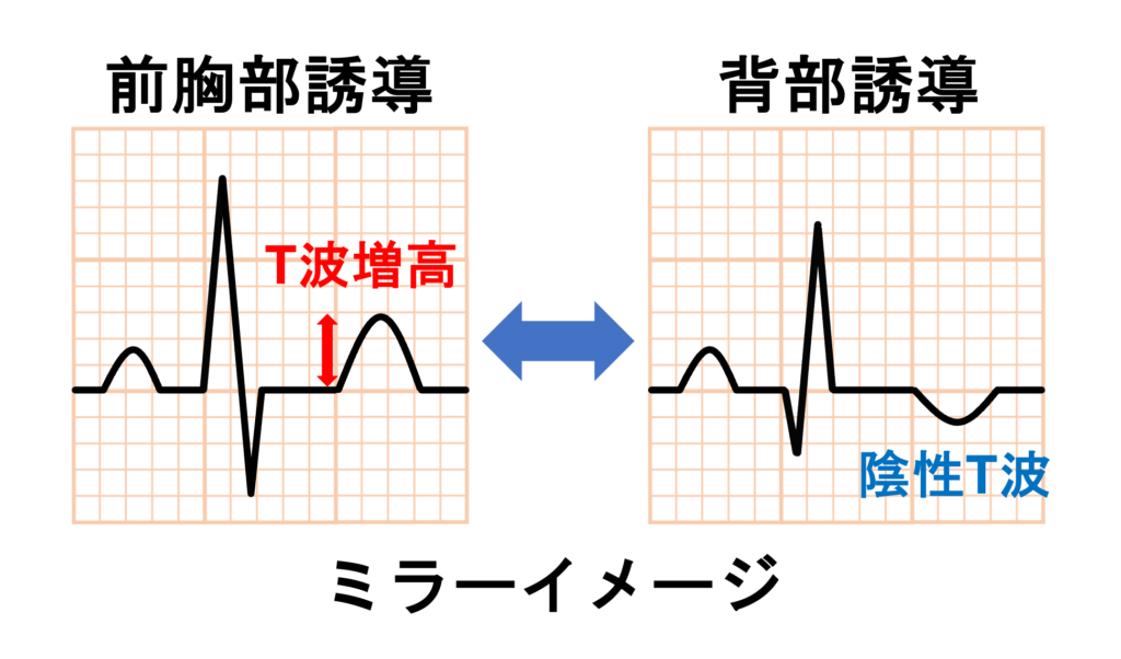 後壁心筋梗塞(posterior myocardial infarction)