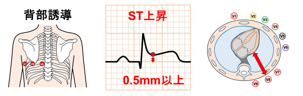 後壁心筋梗塞(posterior myocardial infarction)