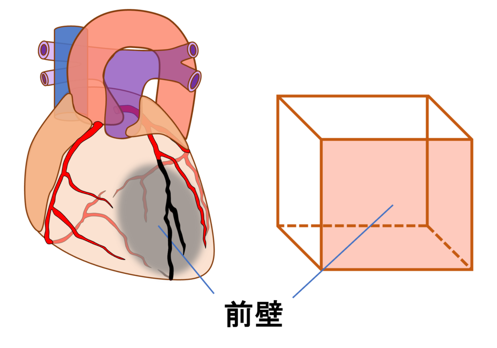 前壁心筋梗塞(anterior myocardial infarction)