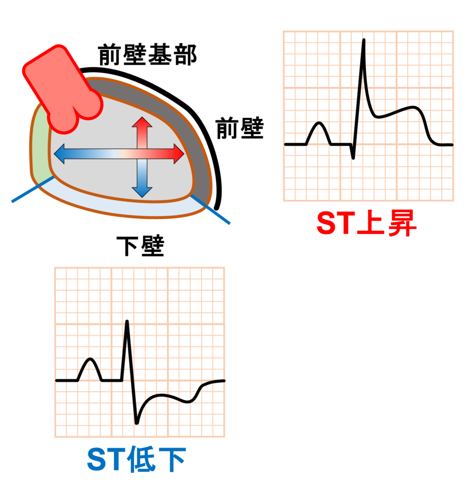 前壁心筋梗塞(anterior myocardial infarction)