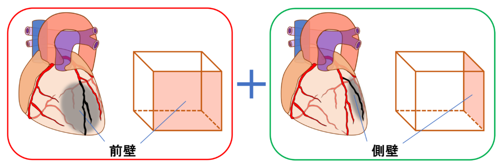 前壁心筋梗塞(anterior myocardial infarction)