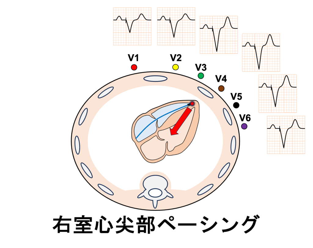 negative concordance
右室心尖部ペーシング