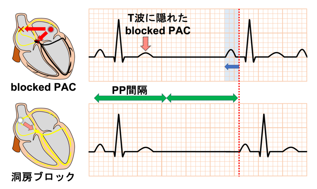 非伝導性心房期外収縮(blocked PAC)