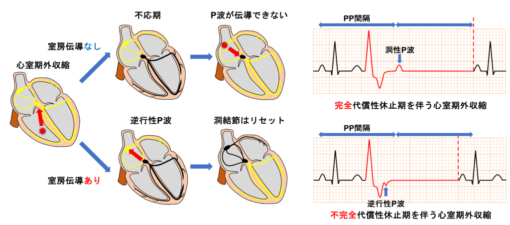 代償性休止期とは？ | 心電図.com