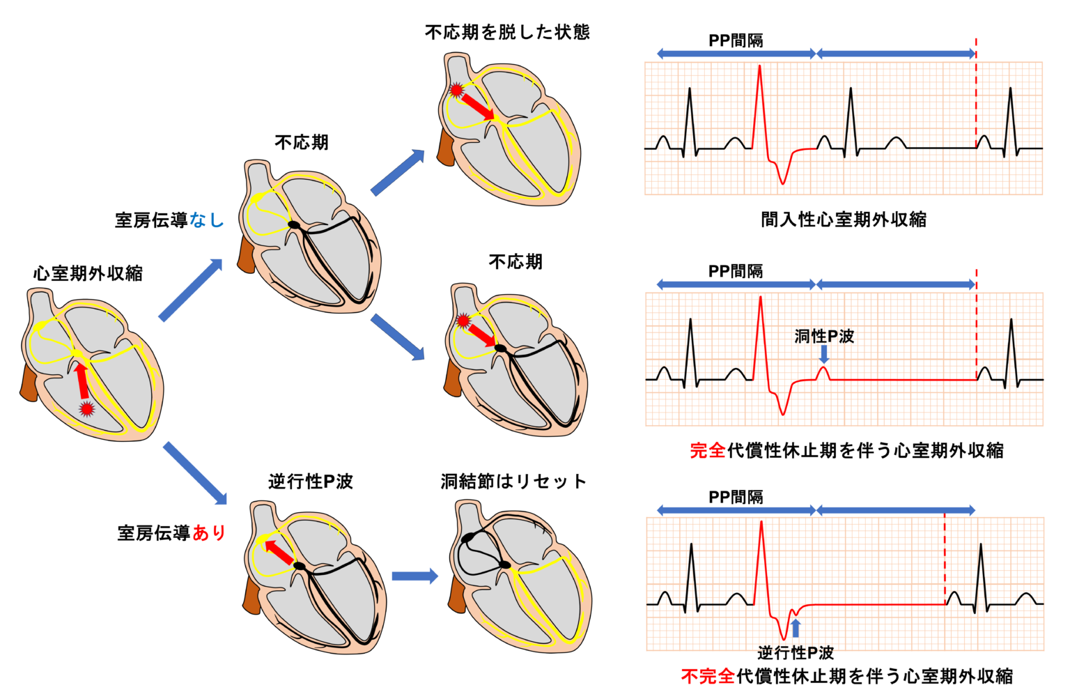 第35例 房室接合部性期外収縮、変行性心室内伝導 | 心室性期外収縮 メカニズム 刺激 – VMZXEW