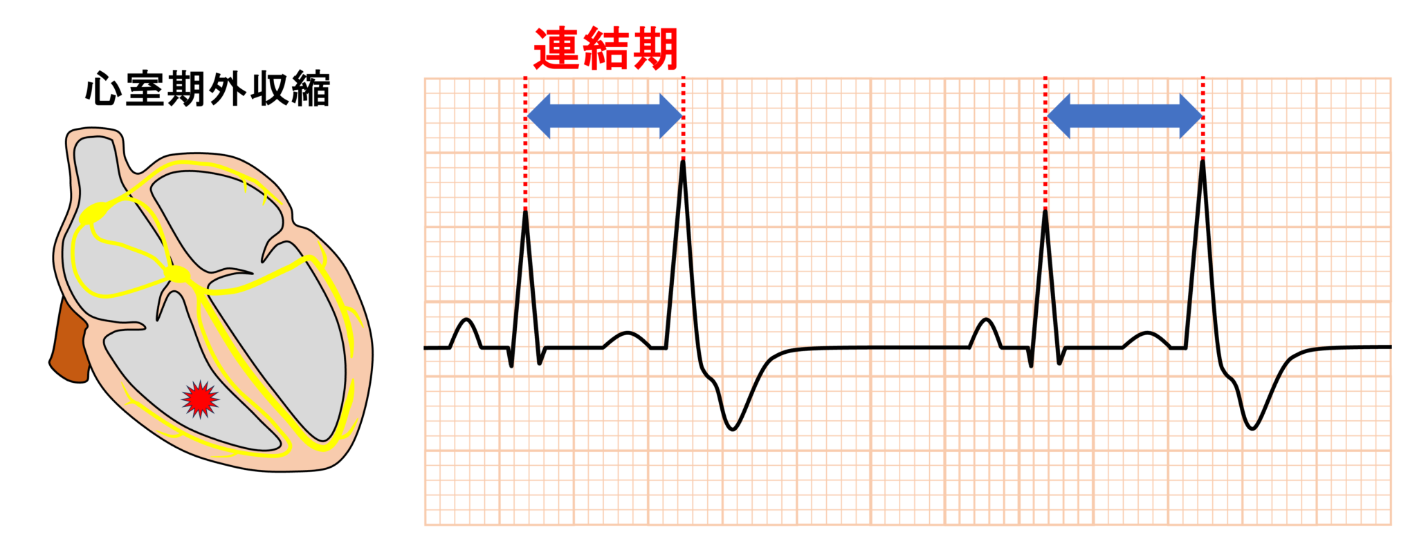 二段脈とは? | 心電図.com