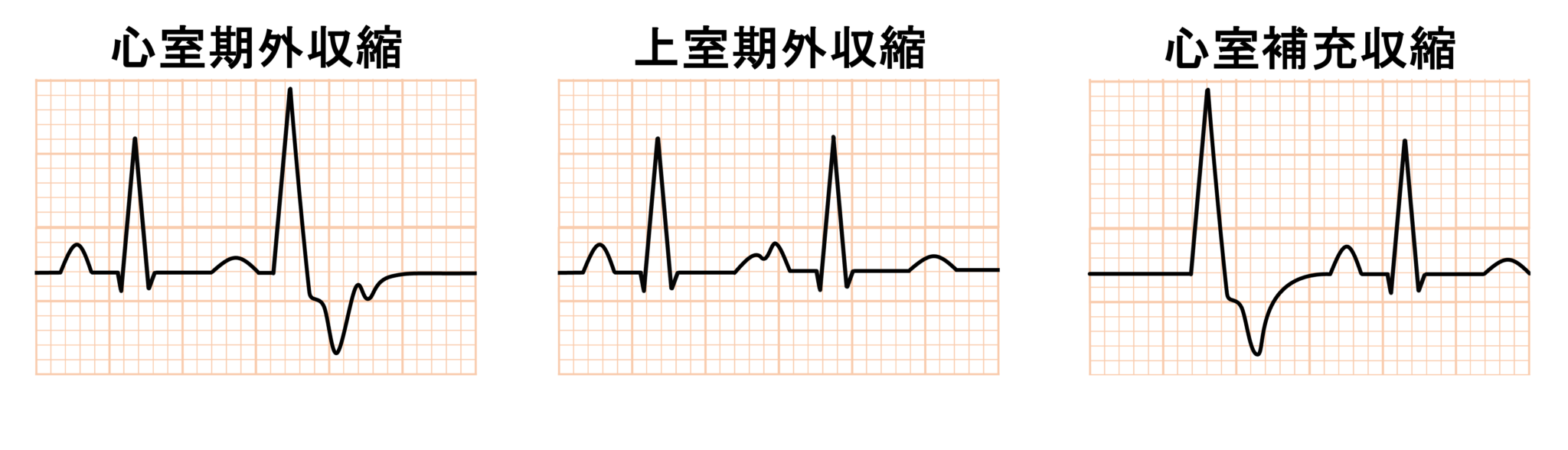 二段脈とは? | 心電図.com