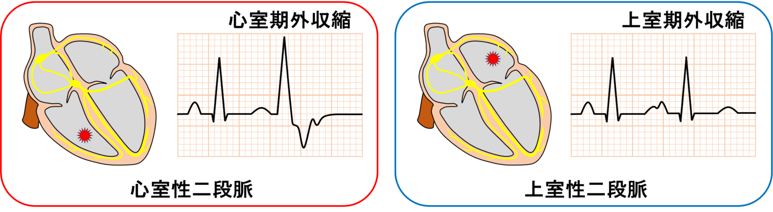 二段脈とは? | 心電図.com