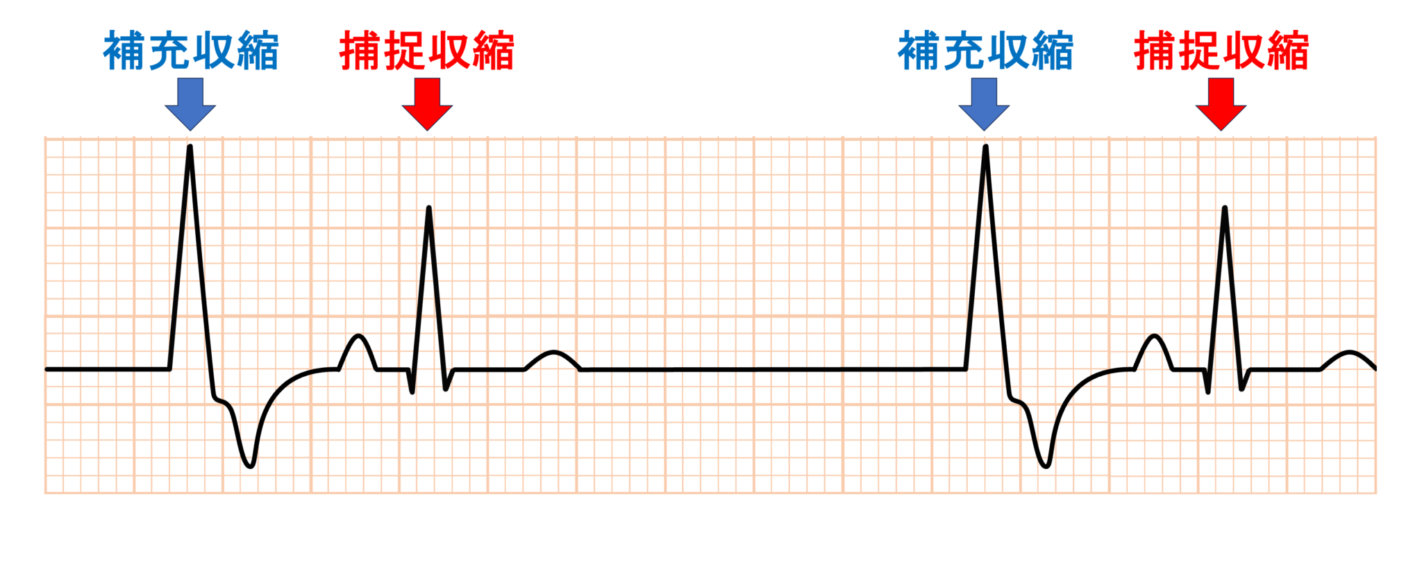 二段脈とは? | 心電図.com