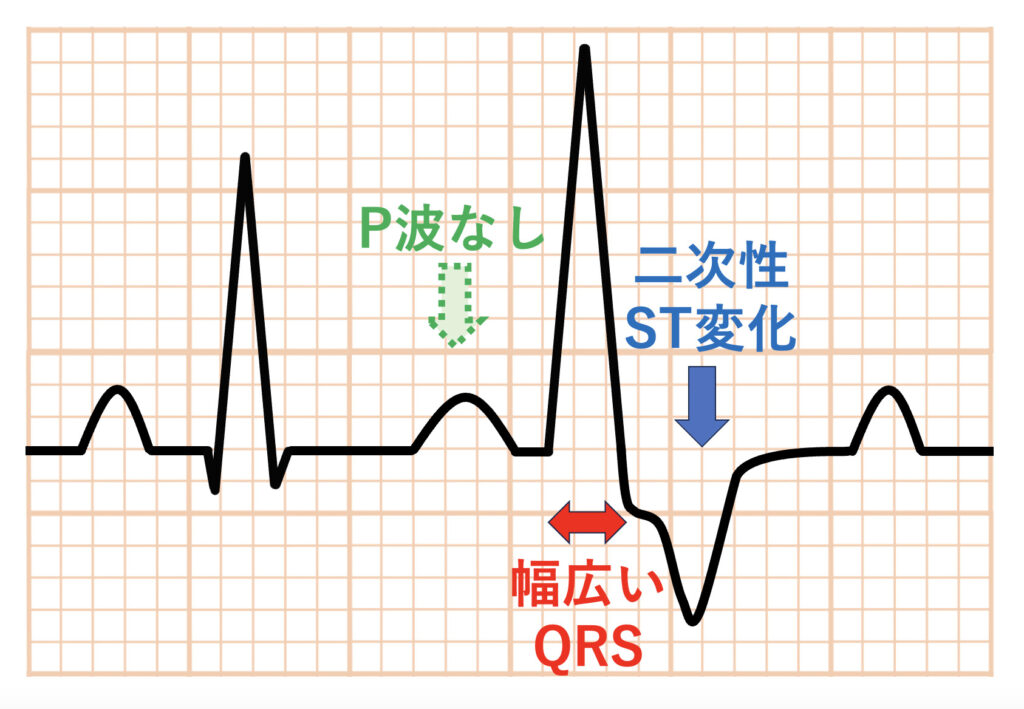 心室期外収縮(Premature Venticular Contraction：PVC)